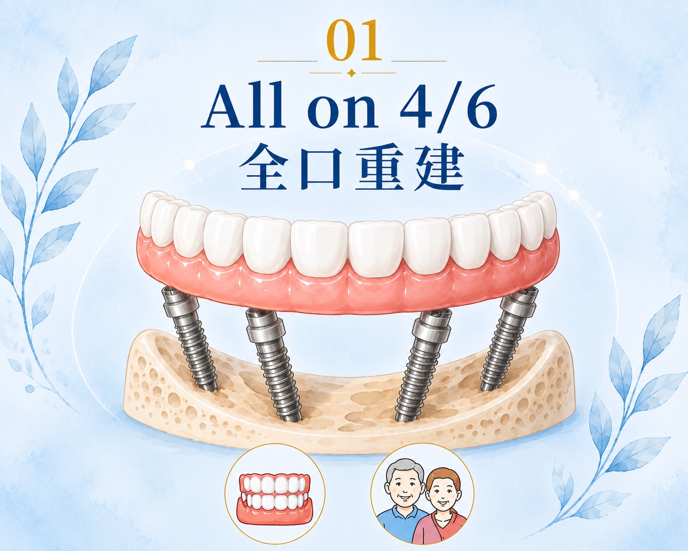 All-on-4 / 全口重建