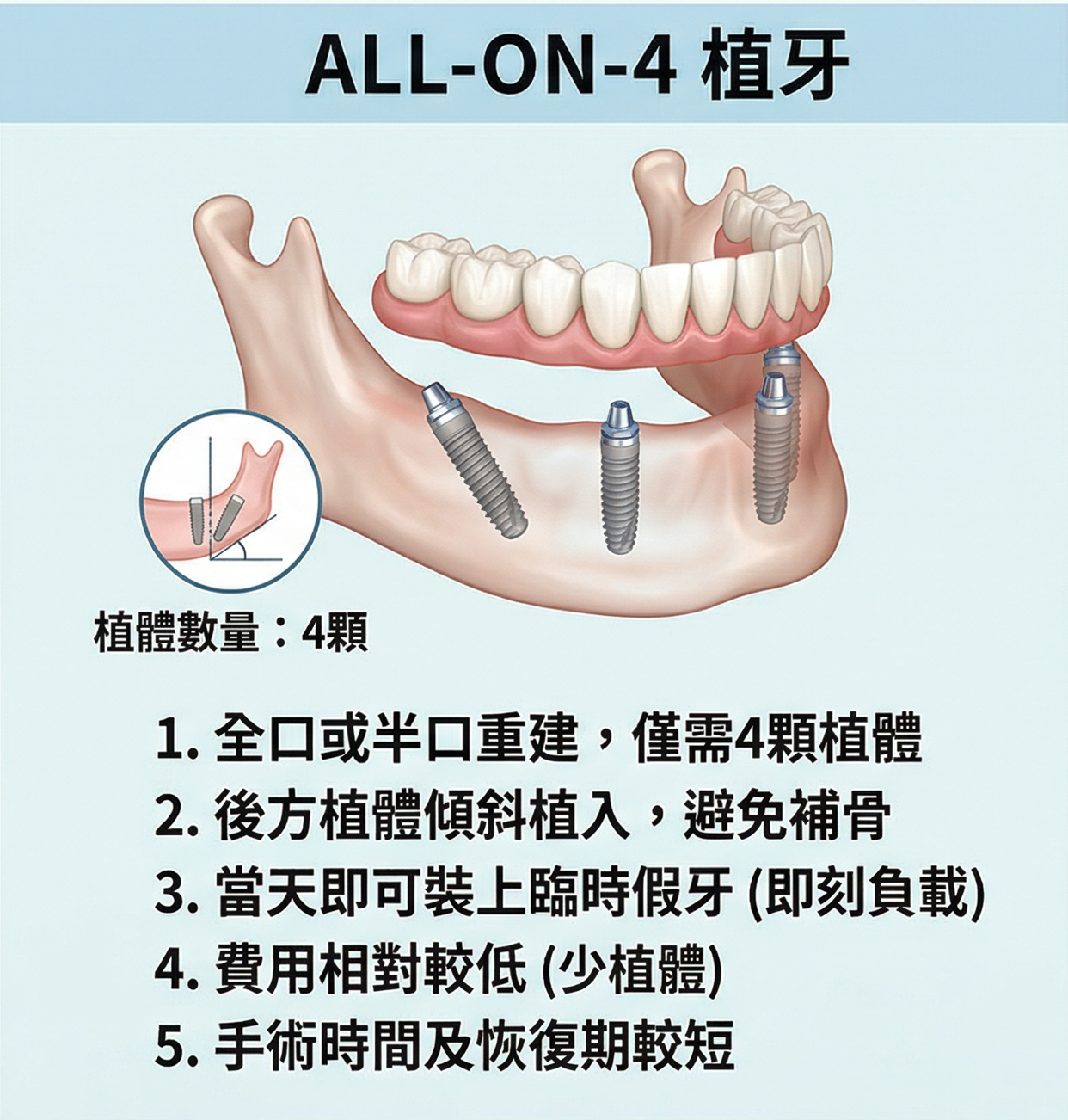 All-on-4 / 全口重建