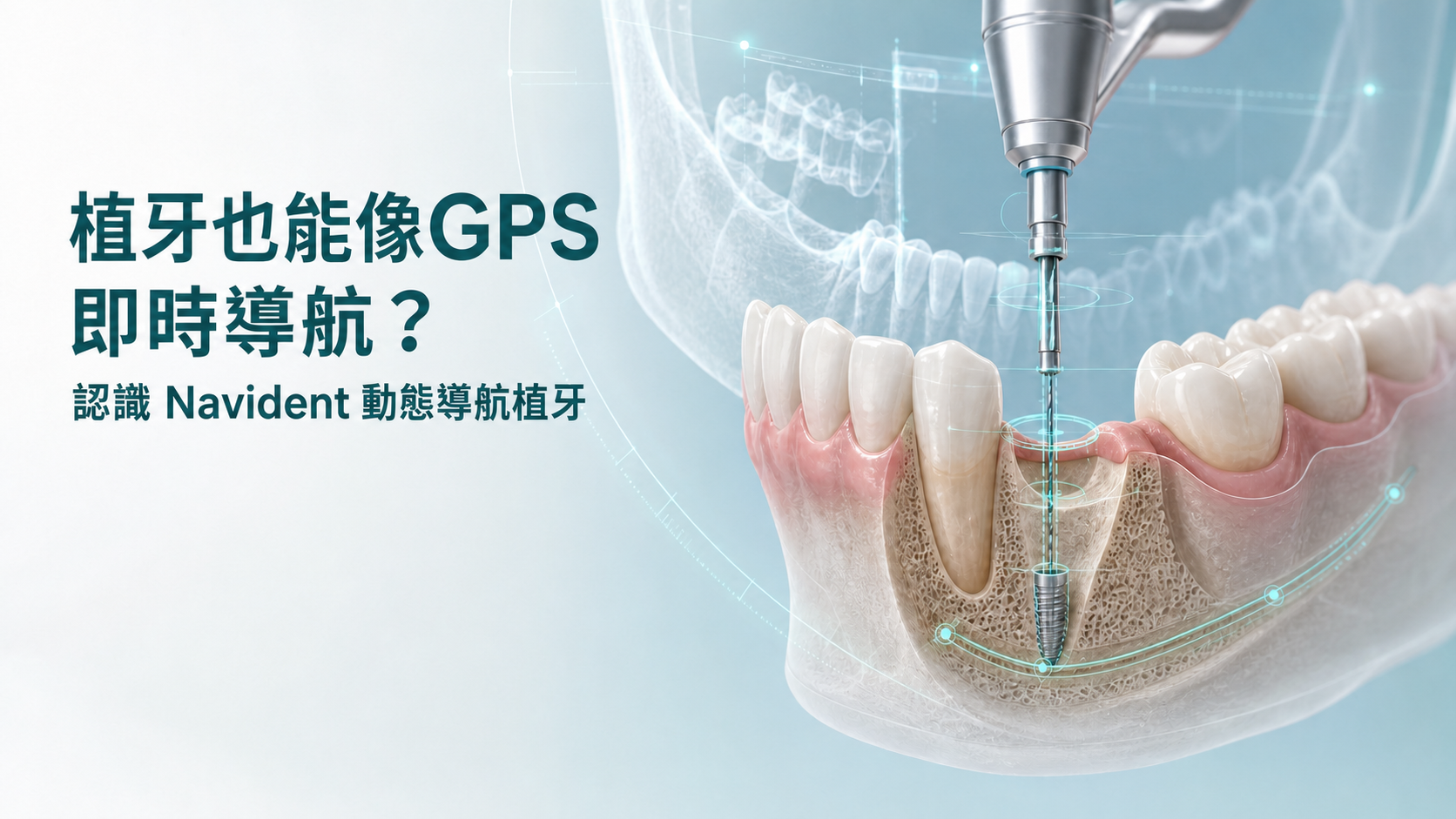  植牙也能像GPS即時導航？認識 Navident 動態導航植牙的趨勢與應用