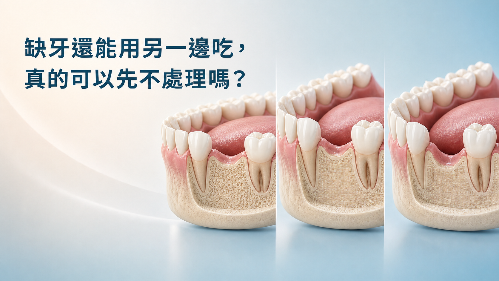 缺牙還能用另一邊吃，真的可以先不處理嗎？把握缺牙重建的黃金時機