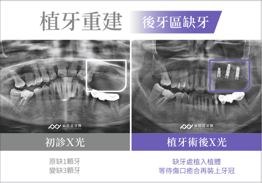 植牙成功案例全收錄，助你找回健康牙
