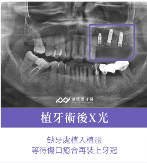 術後示意
