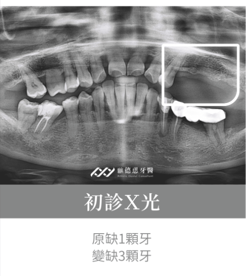 術前示意